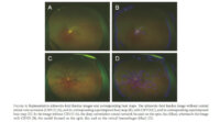 Ristとツカザキ病院眼科、AIを用いて広角眼底画像から網膜中心静脈閉塞症を判定