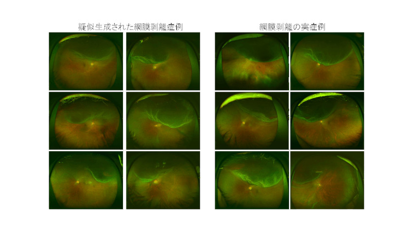 イーグロースとツカザキ病院眼科、AIを活用した網膜剥離の疑似画像生成技術を開発