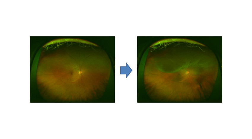 イーグロースとツカザキ病院眼科、AIを活用した網膜剥離の疑似画像生成技術を開発