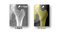 島津製作所、AI活用で高精度な骨密度測定を瞬時に行うX線TVシステムを販売開始